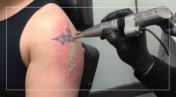 Laser Tattoo Removal - Remove... - Nangia Skin Care Clinic | Facebook